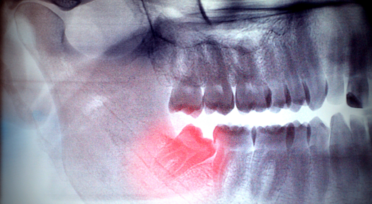 X-ray, panoramic RTG , radiology, photo showing skew wisdom tooth (eight tooth) for removal - purple effect